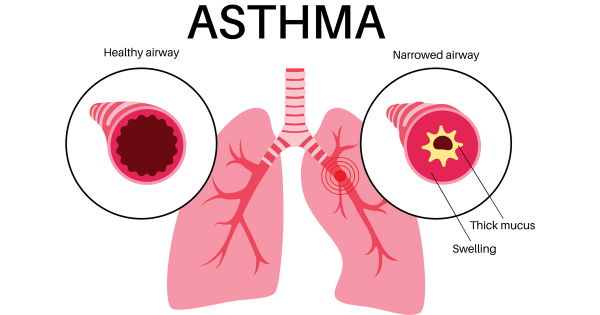 Peak Asthma Season Arrives in September